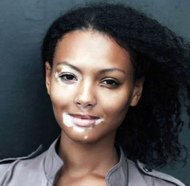 Gros plan sur le traitement du vitiligo